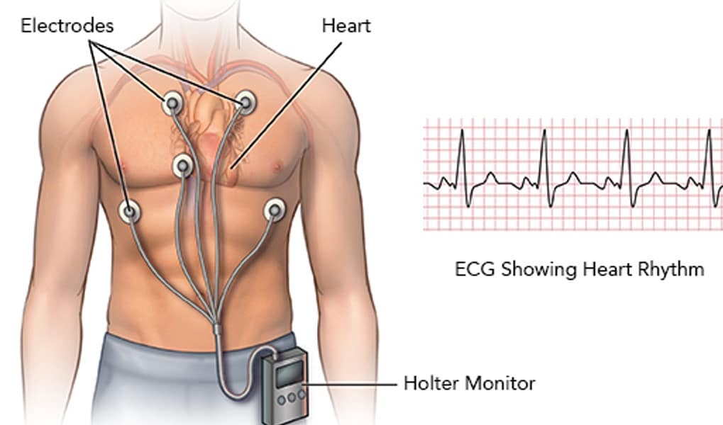 Η φωτογραφία παρουσιάζει το Holter στο σπίτι, προσφέροντας αποτελεσματική παρακολούθηση του καρδιακού ρυθμού στην άνεση του οικιακού σας περιβάλλοντος. Με αυτό το σύστημα, η παρακολούθηση της καρδιακής υγείας γίνεται εύκολη και προσαρμόσιμη στην καθημερινή ζωή σας. Holter κατ οίκον